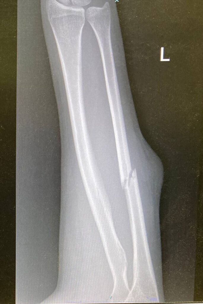 «Я поповзла в бік палаючого будинку»: поселенці розбили голову активістці