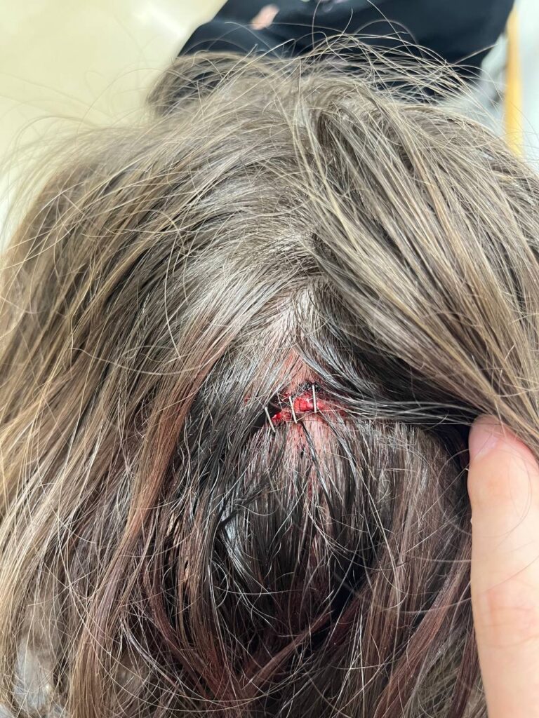 «Я поповзла в бік палаючого будинку»: поселенці розбили голову активістці