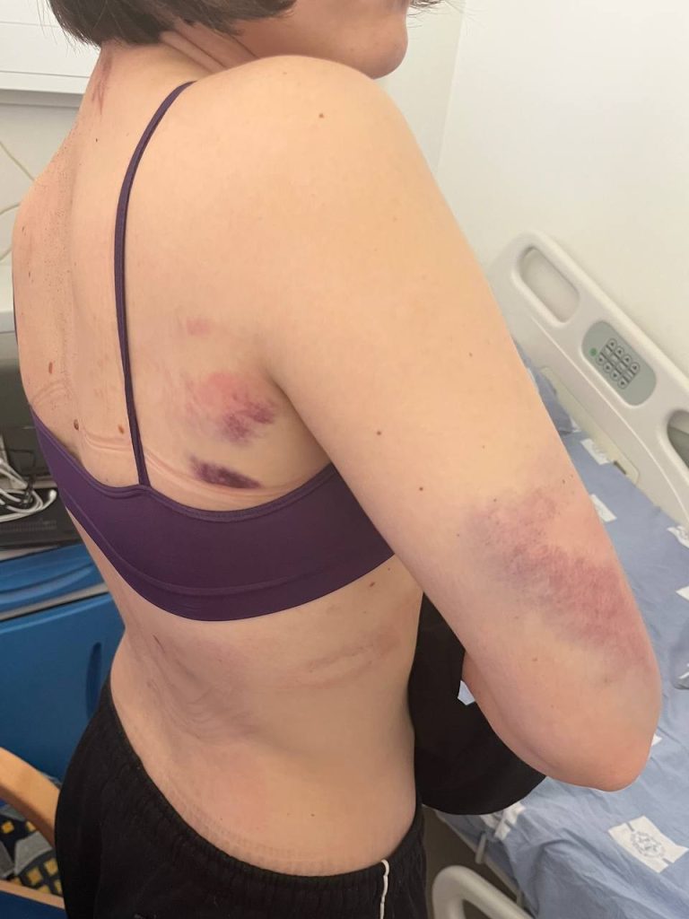 «Я поповзла в бік палаючого будинку»: поселенці розбили голову активістці